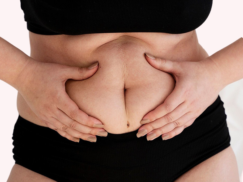 Abdominoplastia