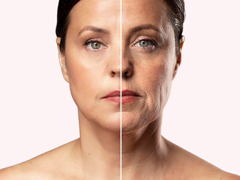 Ritidoplastia ou Lifting facial DEEP PLANE